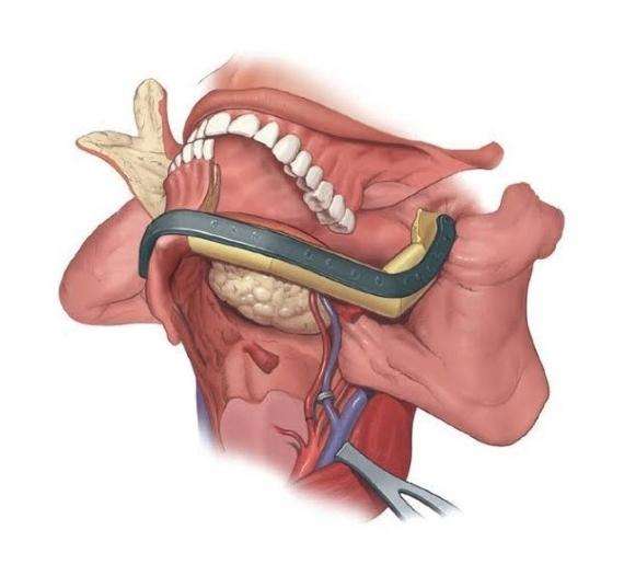 Head Neck Cancer Surgeires with Reconstration